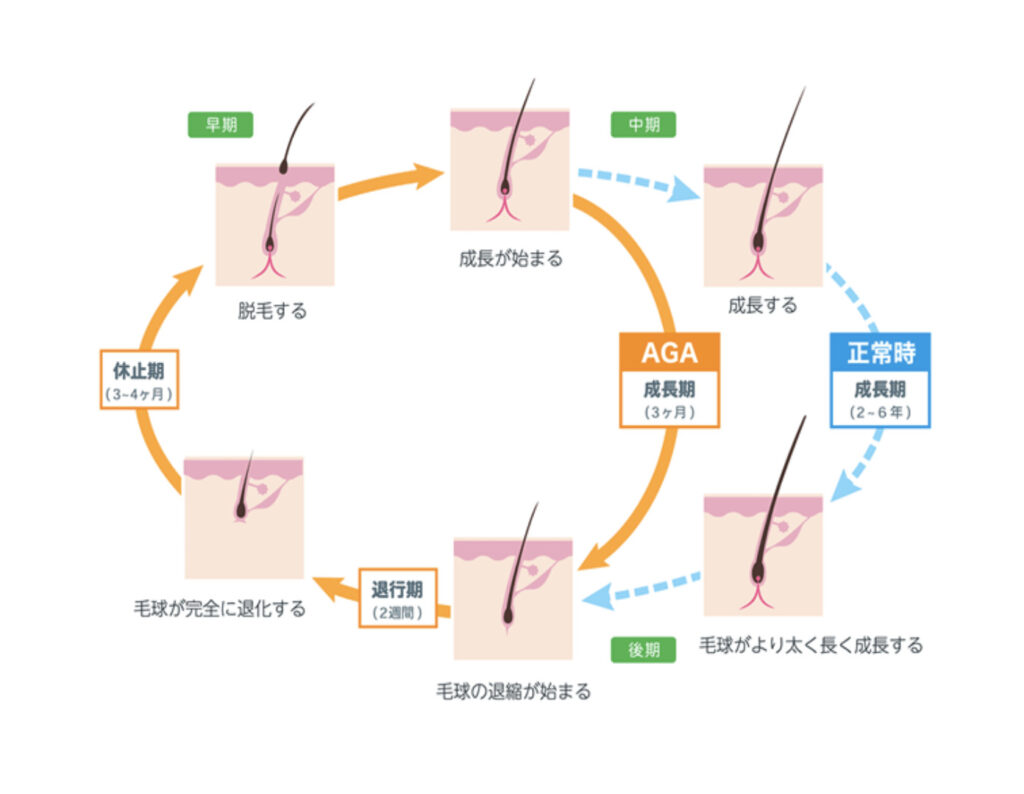 ハゲる原因・毛髪サイクル